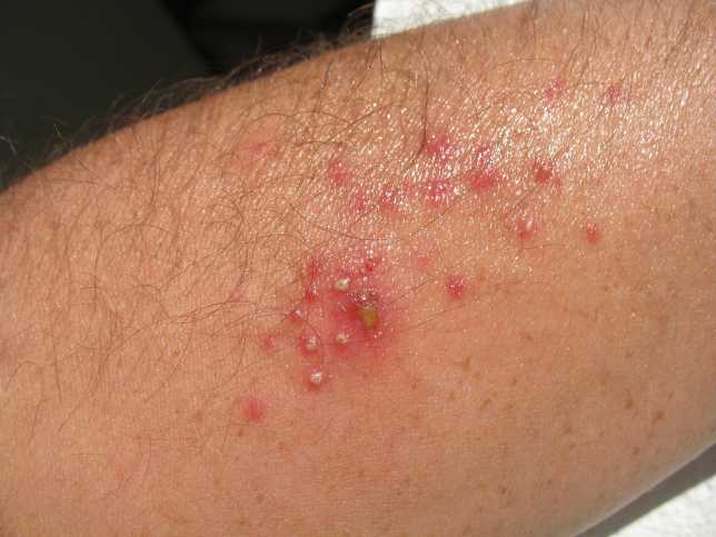 bacterial infection on skin pictures, photos