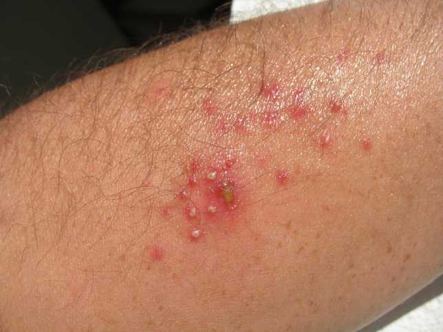 Can Gut Bacteria Cause Skin Rash