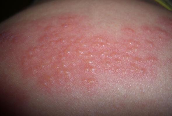 Mild Shingles Rash Pictures Pictures Photos 8635