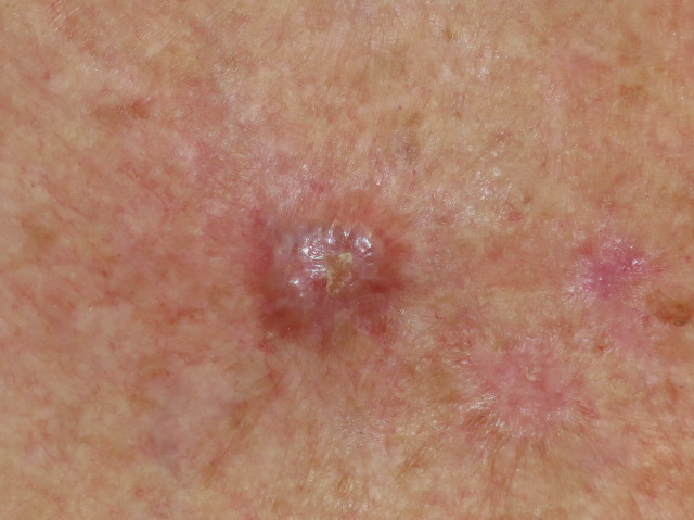 Basal Cell Carcinomas Pictures Photos