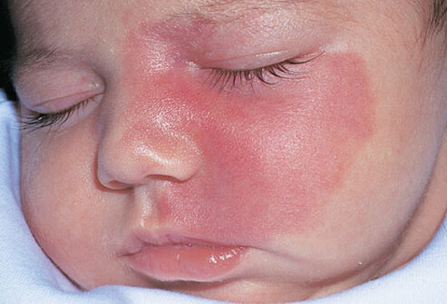 port wine stain birthmark - pictures, photos