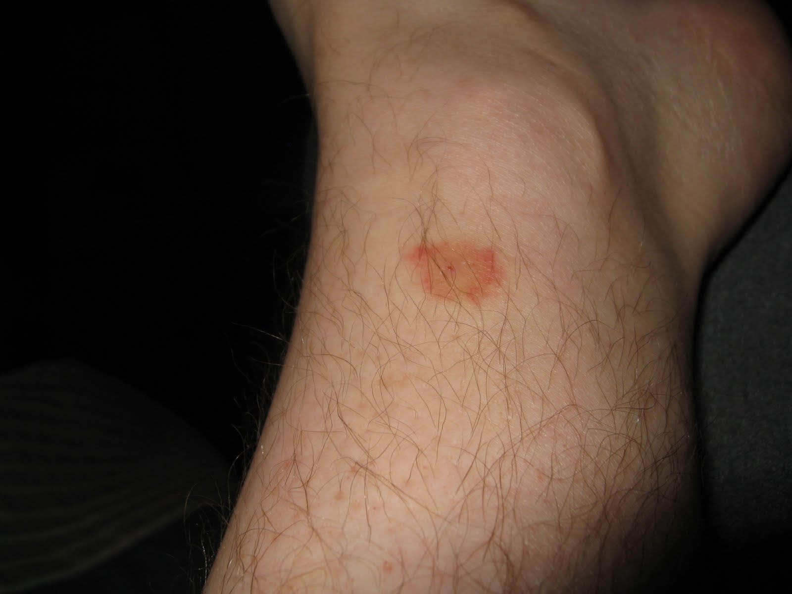bites around ankles pictures, photos