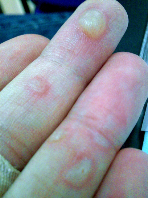 blister-on-finger-pictures-photos