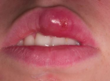 what does blue around the lips mean what does blue around the lips mean