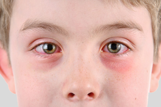 pink eye symptoms in adults - pictures, photos