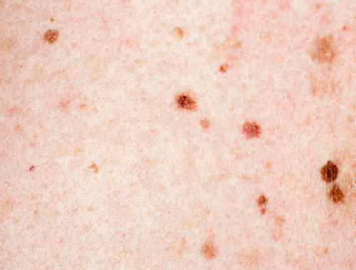 Little Brown Spots On Skin Pictures Photos