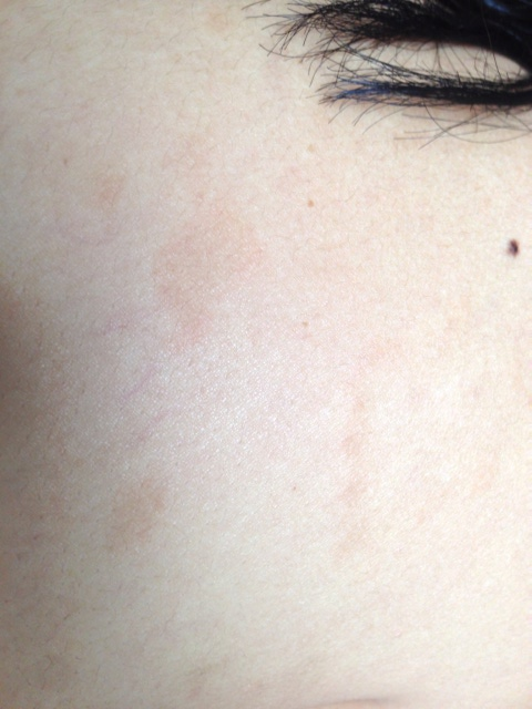 brown spots on back - pictures, photos