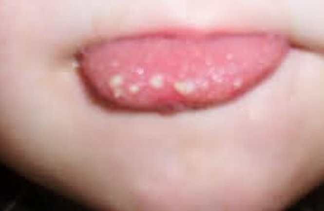 Big White Bump On Bottom Of Tongue