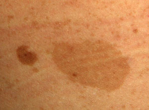 flat brown spots on skin - pictures, photos