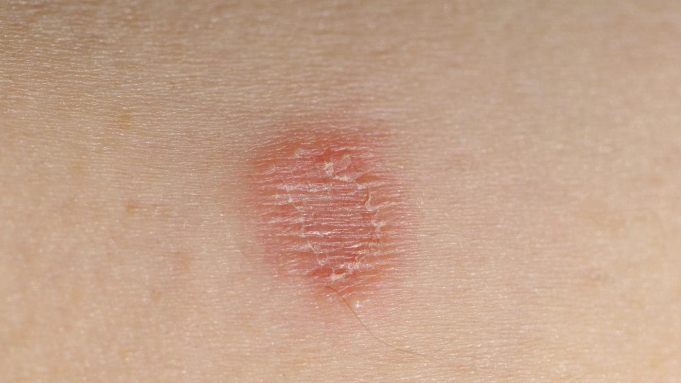 what to use for ringworm pictures, photos