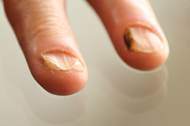 infection-in-fingernails-pictures-photos