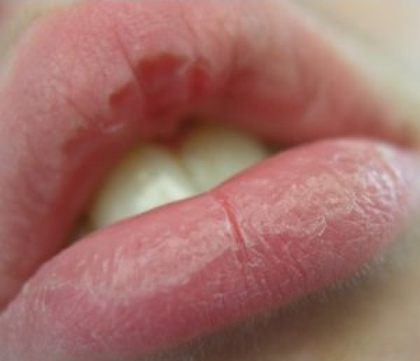 swollen-chapped-lips-pictures-photos