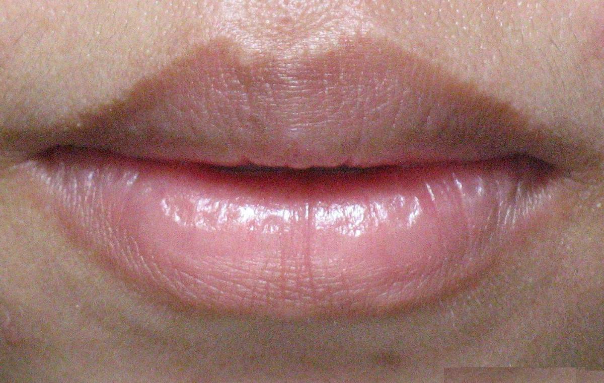 infection-on-lips-pictures-photos