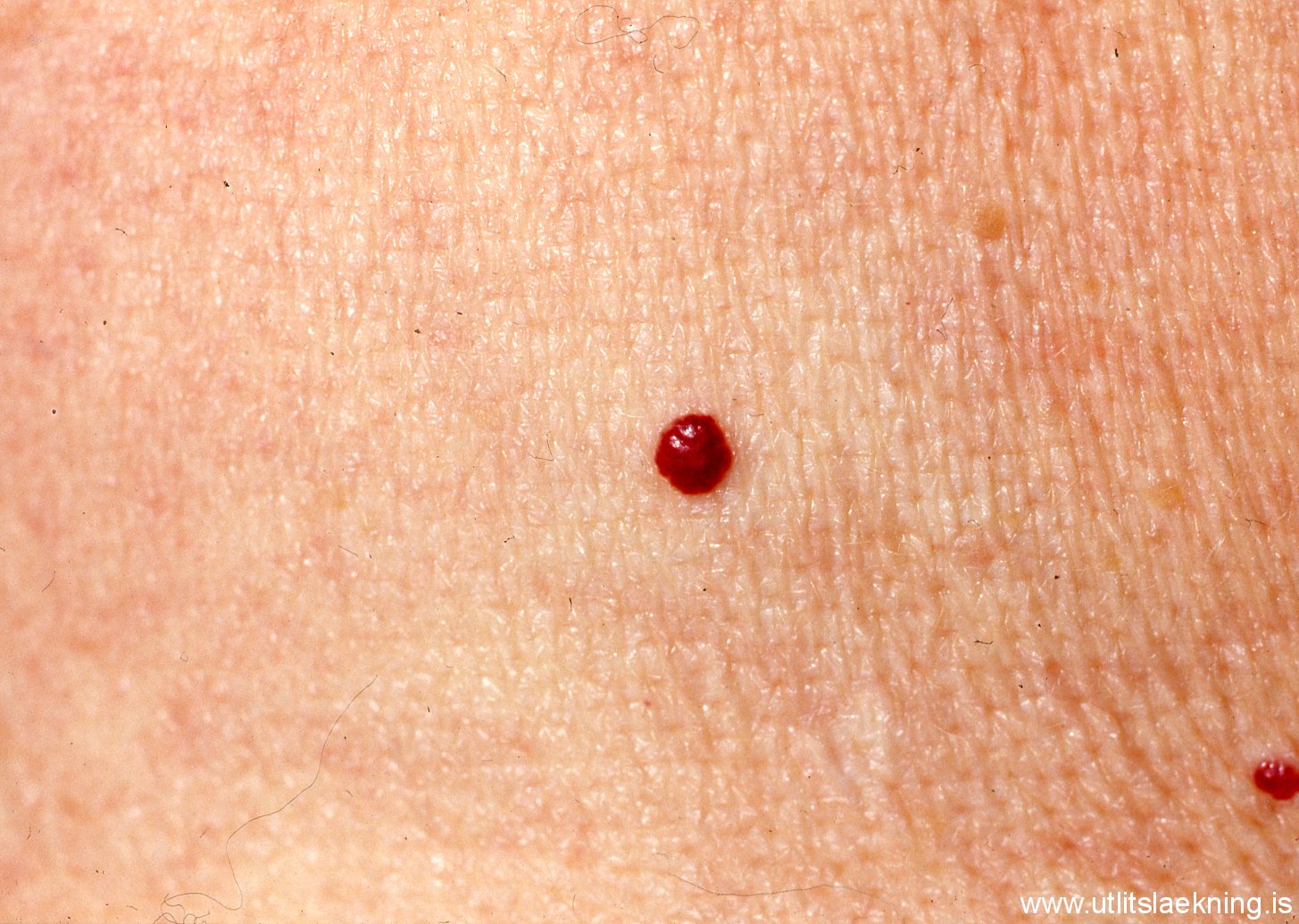 angioma pictures - pictures, photos