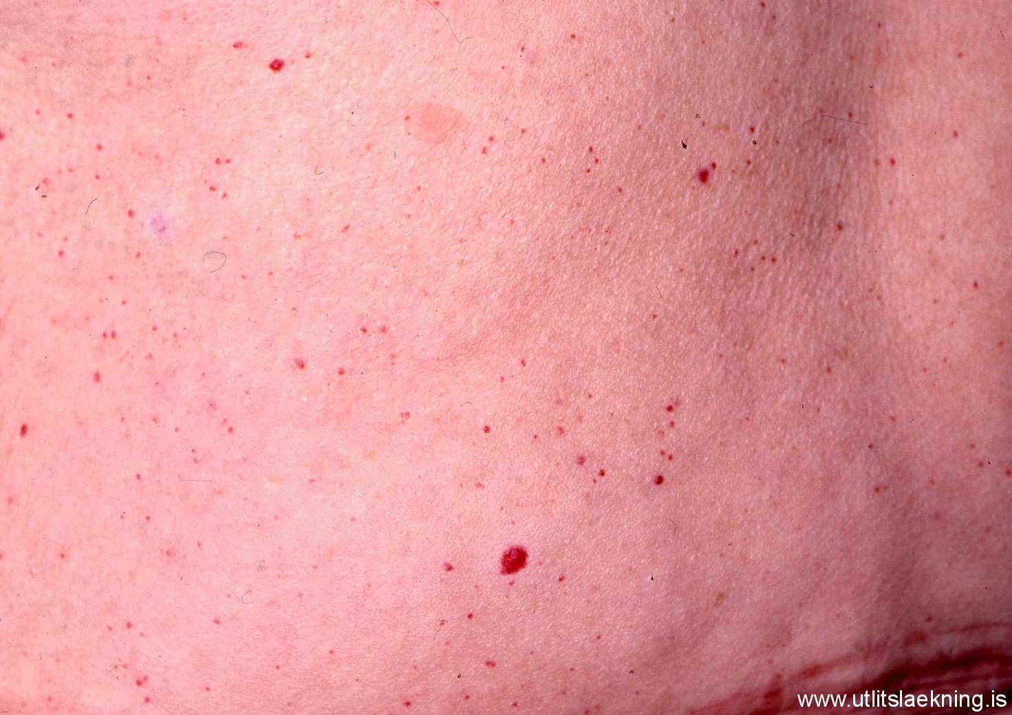 cherry-angiomas-pictures-photos