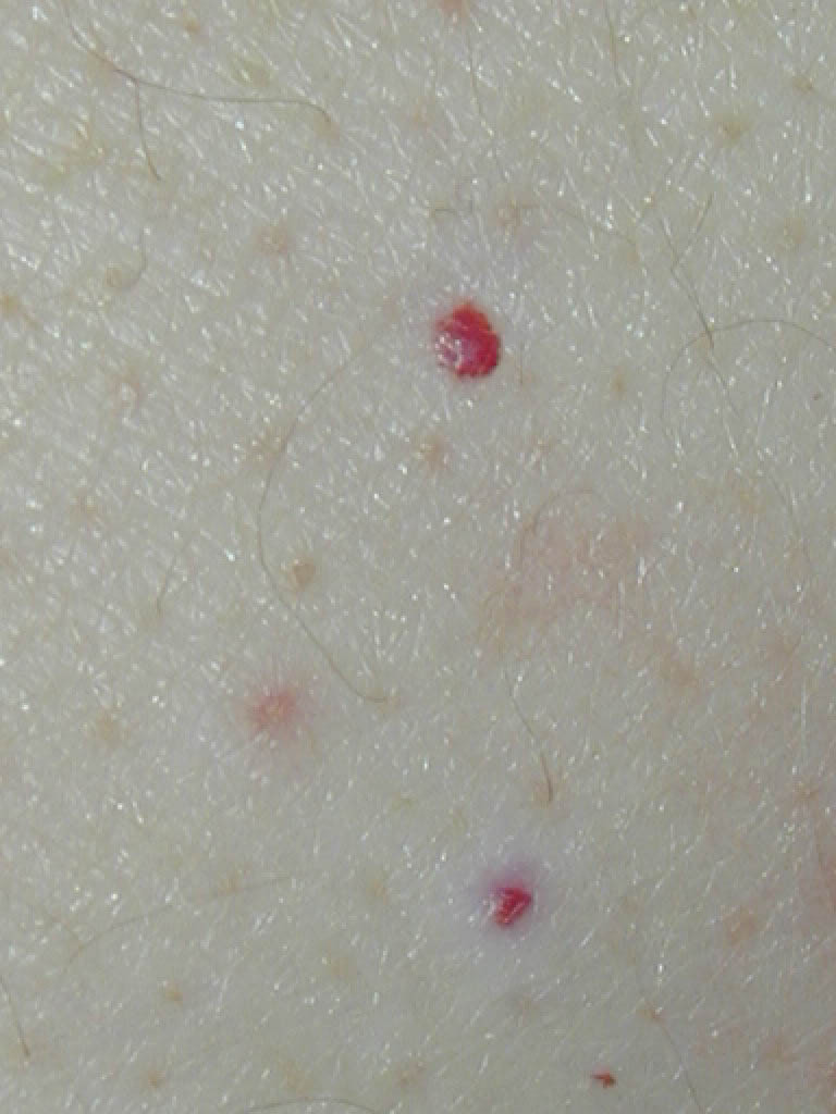 angiomas picture - pictures, photos