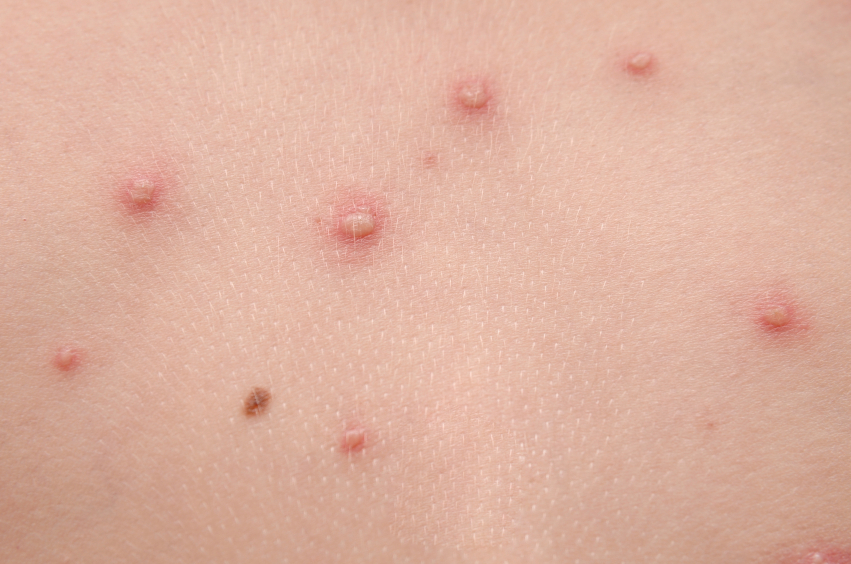 pics-of-chickenpox-pictures-photos