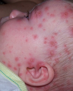 babies chicken pox - pictures, photos