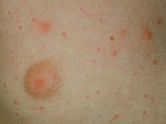 cholinergic urticaria symptoms pictures, photos cholinergic urticaria symptoms pictures, photos
