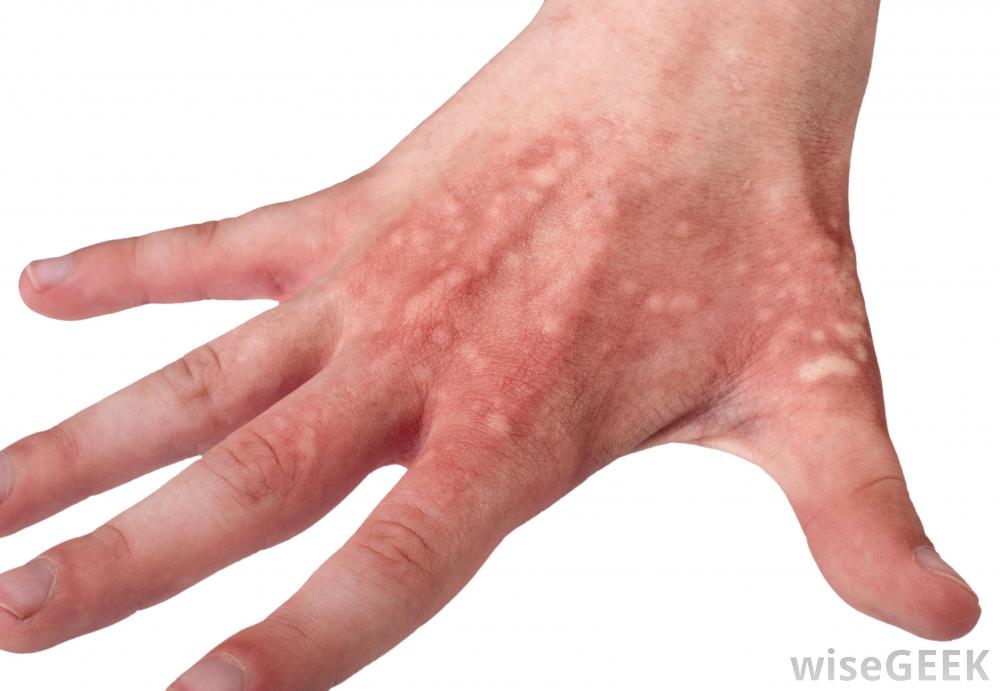 Watery Blisters On Hands Pictures Photos