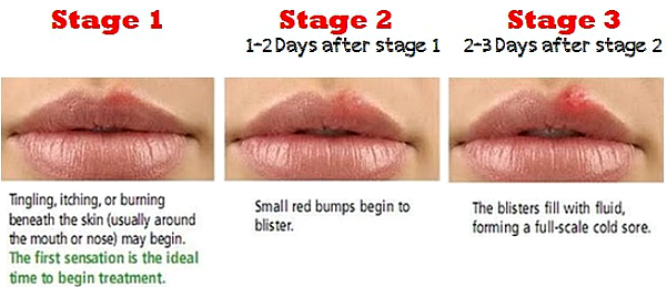 Lip Sores Types