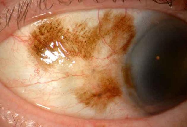 melanosis eye - pictures, photos