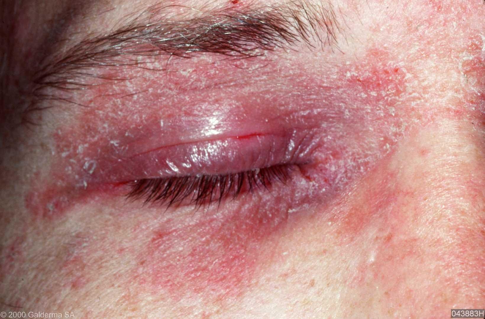 dermatitis-on-eyelids-pictures-photos