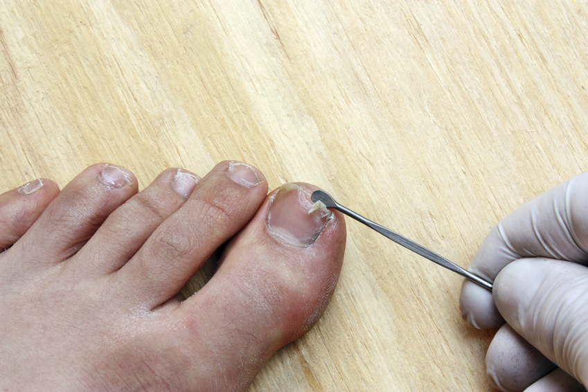 Toenail Cracking In The Middle Pictures Photos