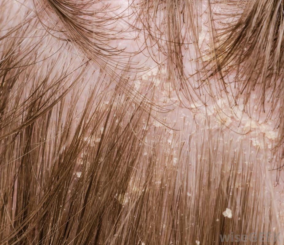 scalp disorders - pictures, photos