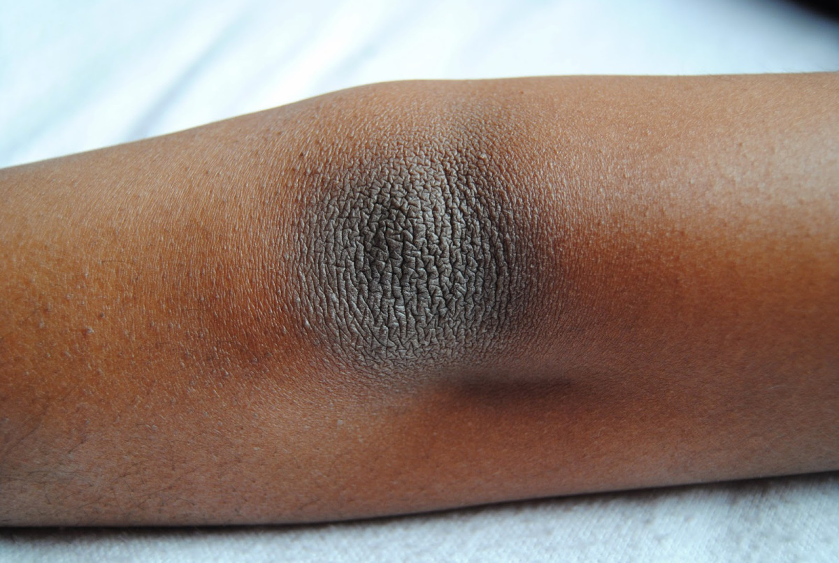 dry-skin-on-lower-legs-pictures-photos