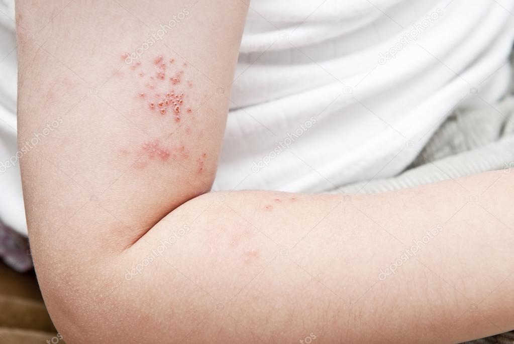 rash-from-flu-shot-pictures-photos