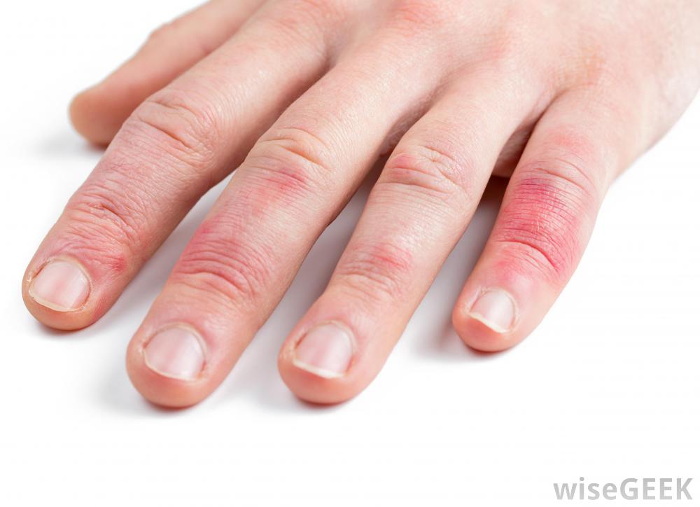 painful-recurrent-rash-on-the-fingers-clinical-advisor