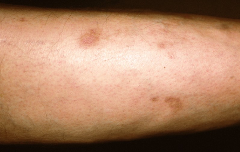 dermopathy-pictures-photos