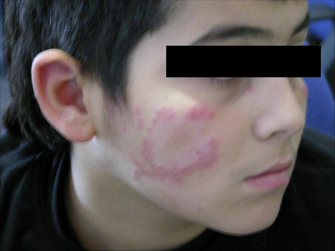 discoid lesions pictures, photos