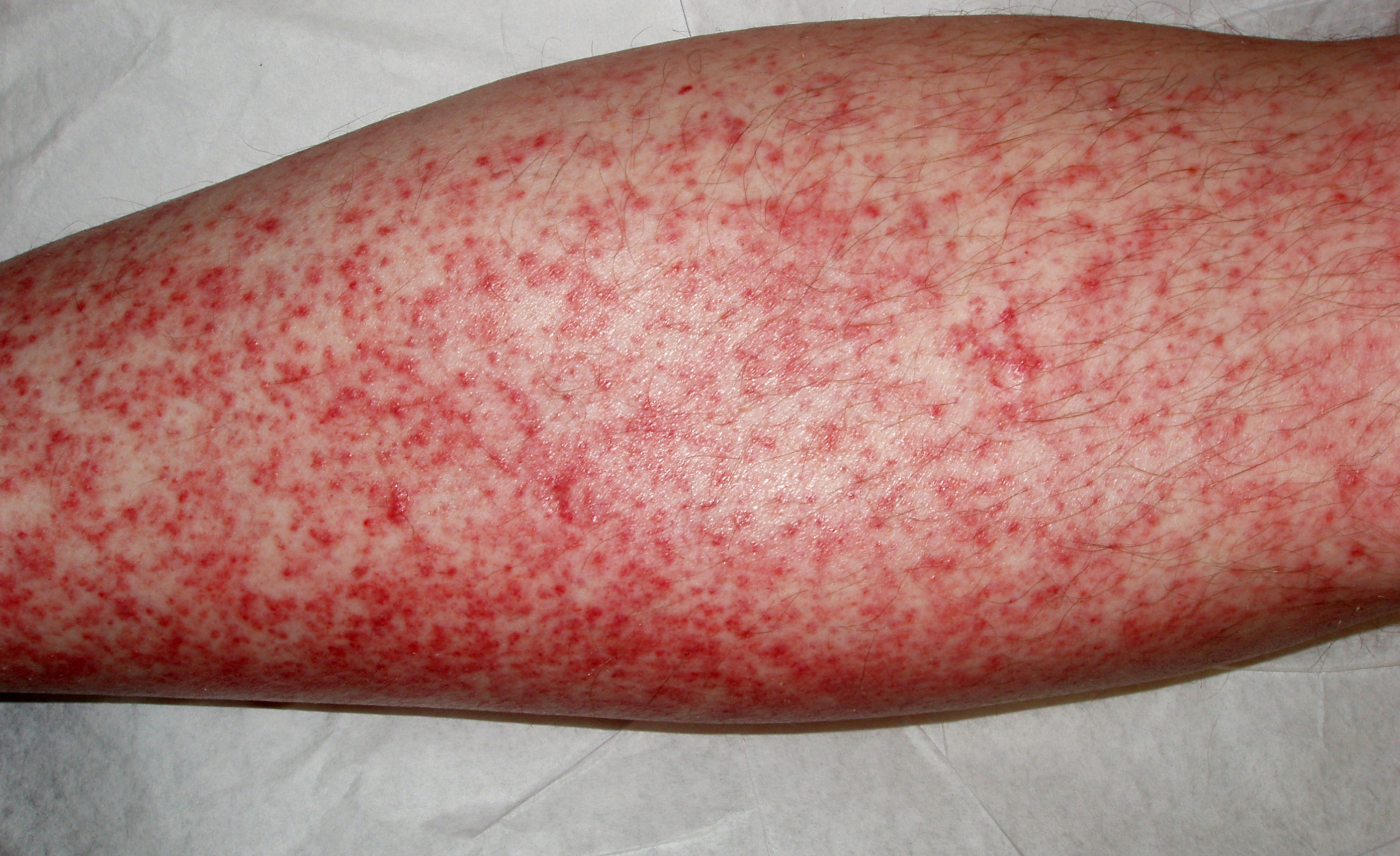 Drug Hypersensitivity Syndrome Pictures Photos