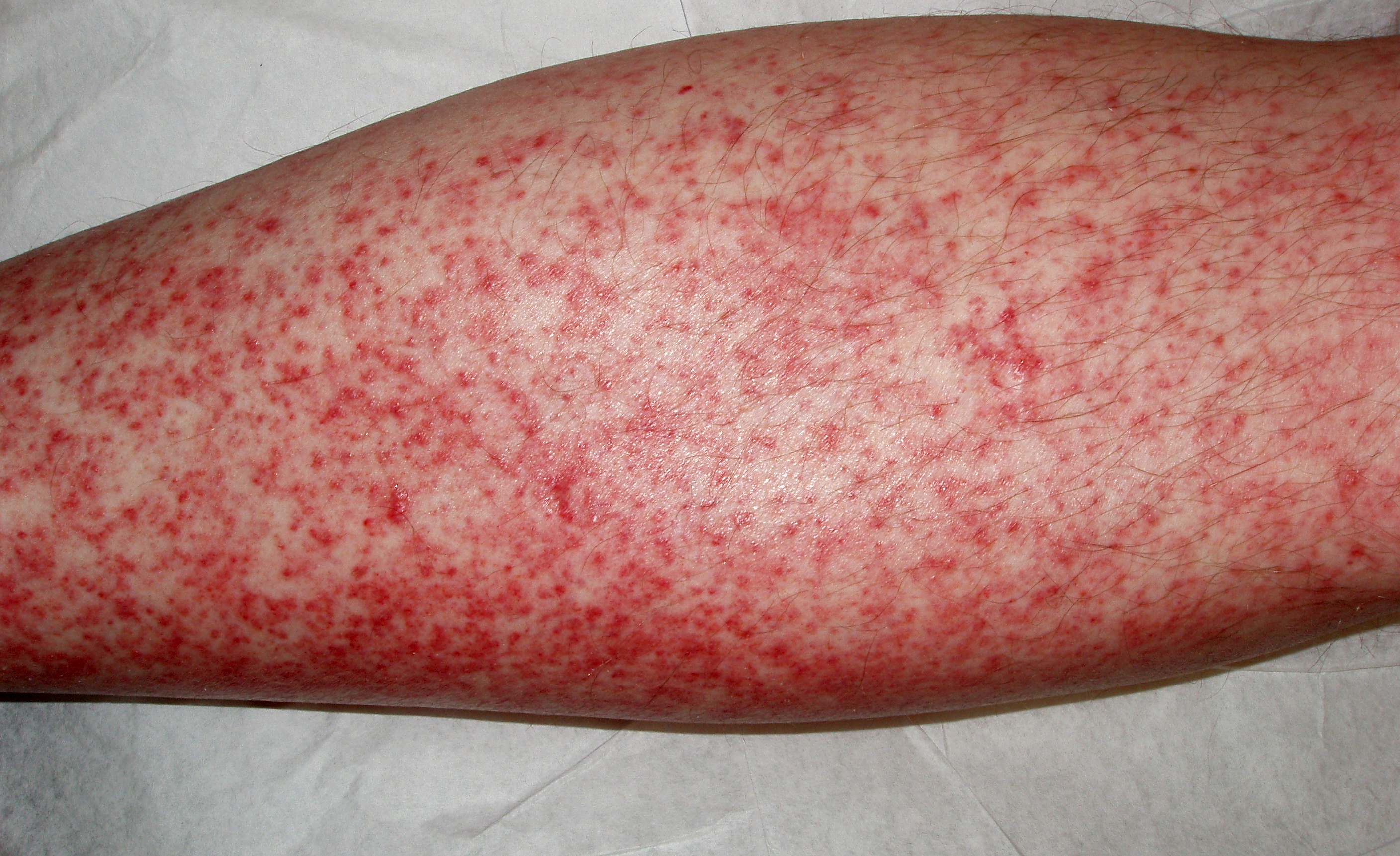 drug hypersensitivity syndrome - pictures, photos