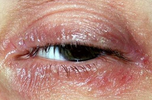 scaly eyelid - pictures, photos