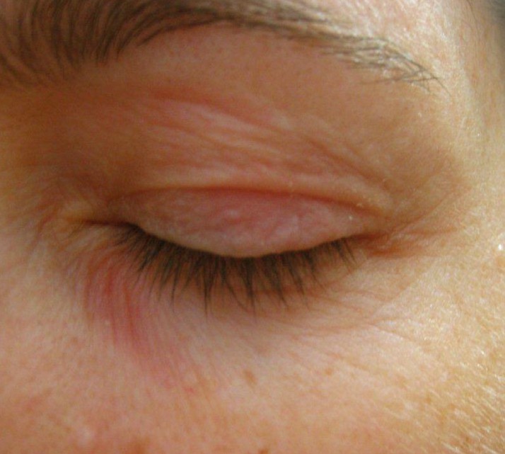 dry-flaky-skin-around-eyes-pictures-photos