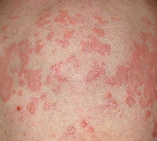 dry skin rashes - pictures, photos