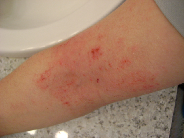 rashes-in-elbow-creases-pictures-photos