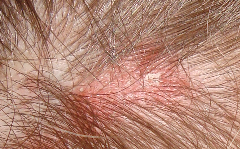 Itchy Spots On Skin And Scalp