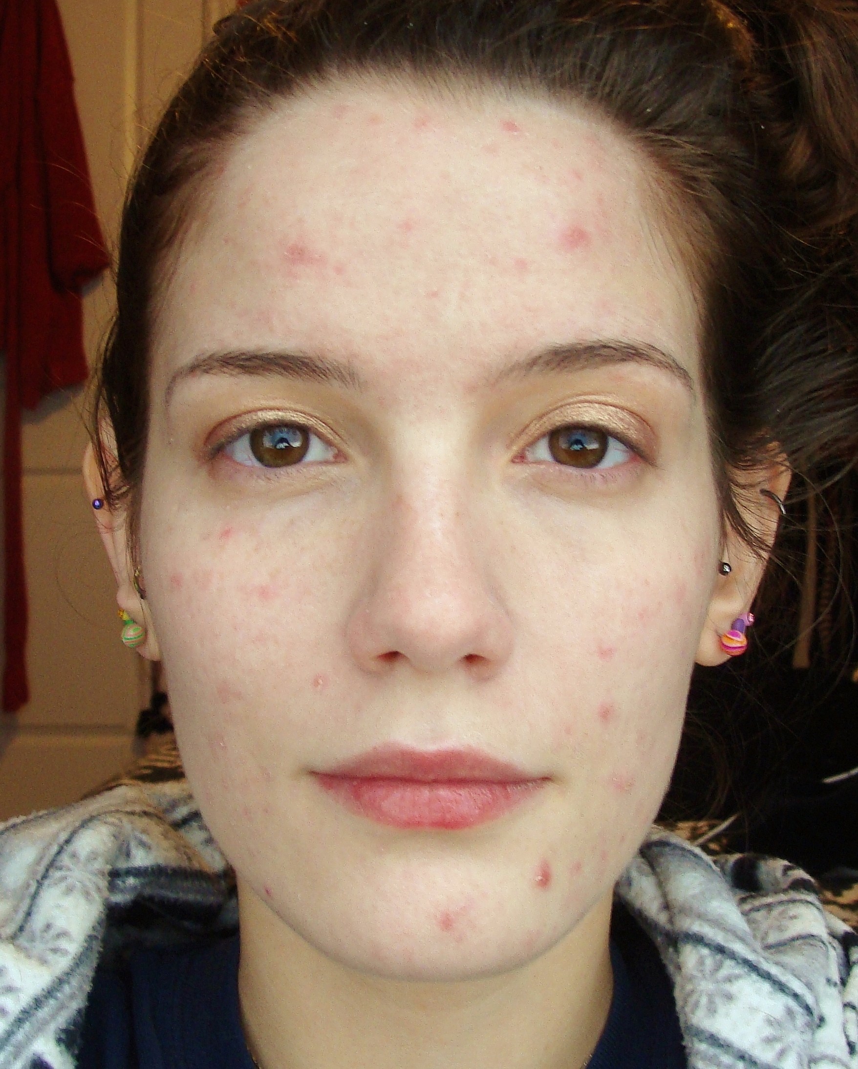Mild Acne Pictures Photos