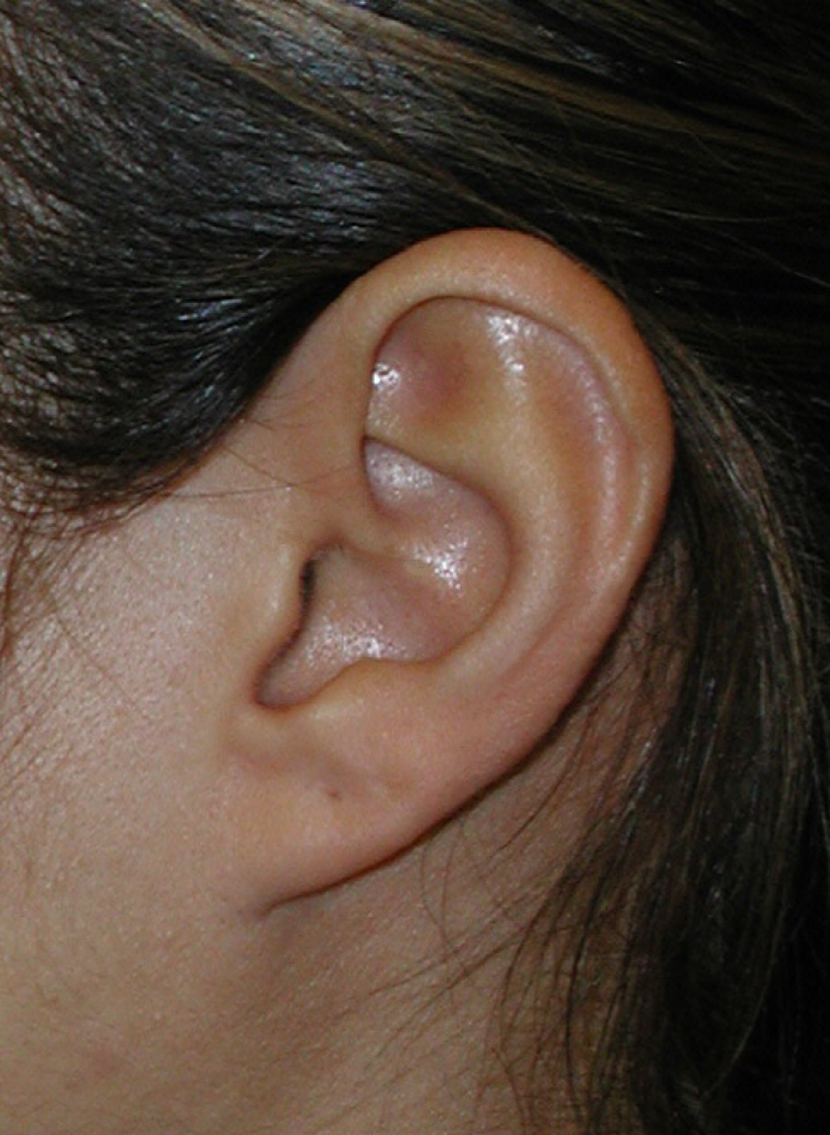 Lump In Ear Cartilage Pictures Photos