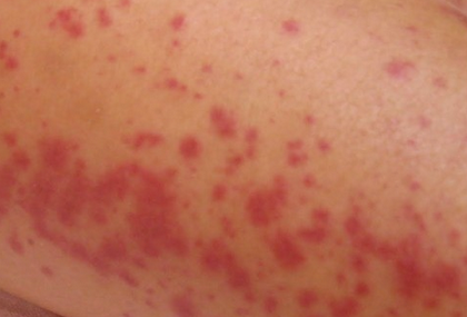 diabetes legs rash - pictures, photos