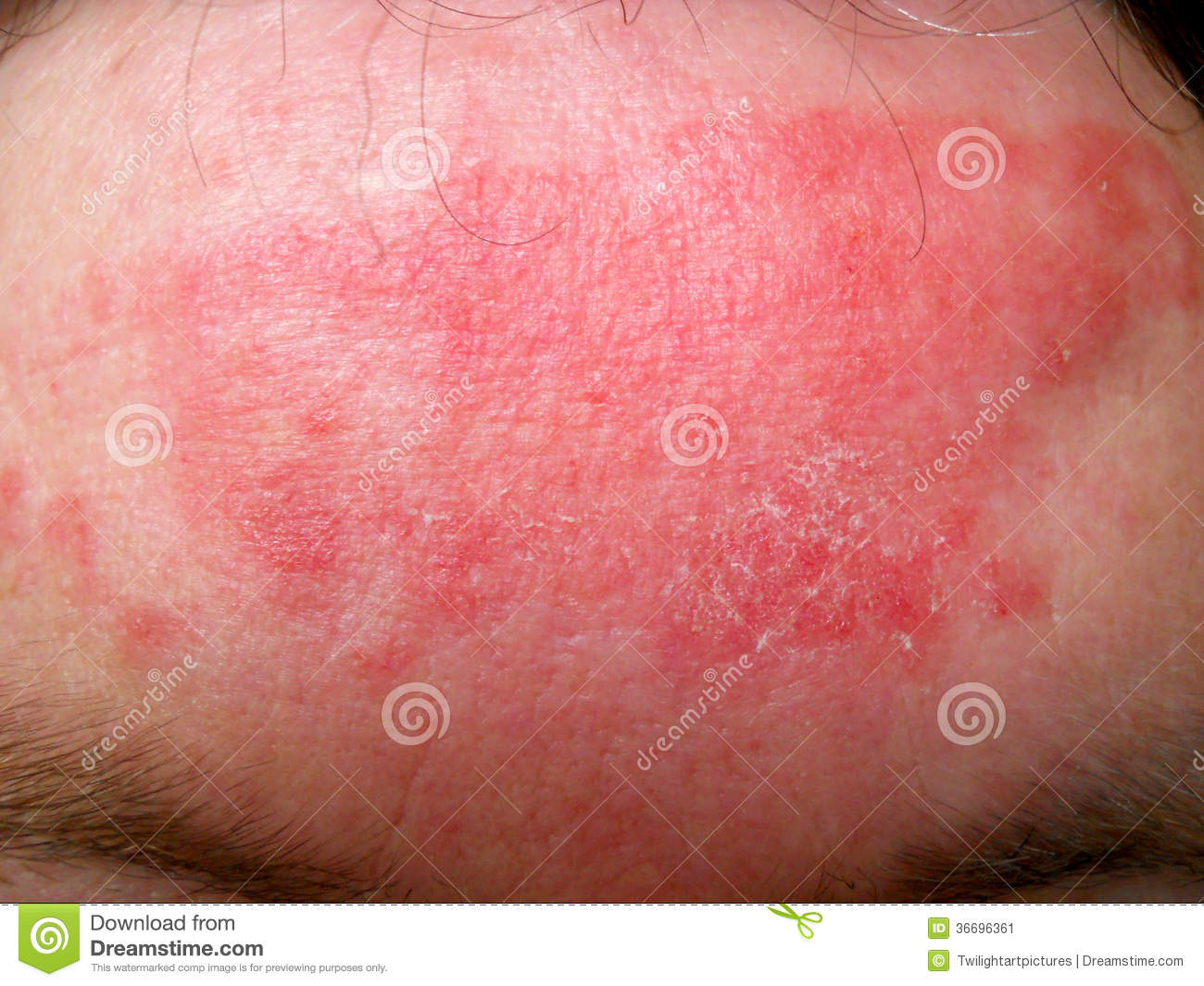 eczema on forehead pictures, photos