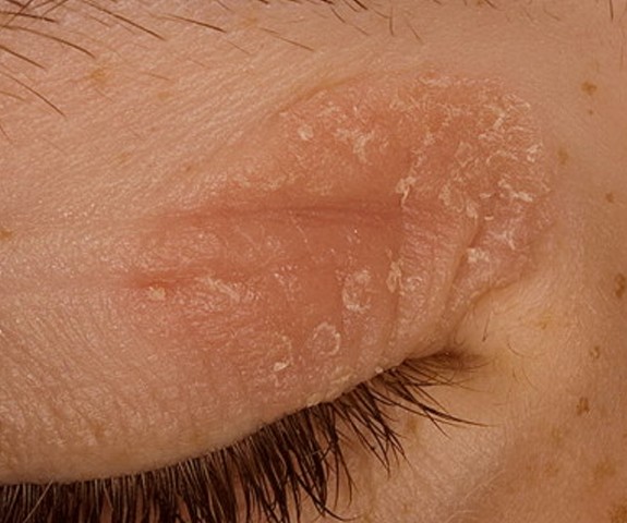 eyelid-eczema-pictures-photos