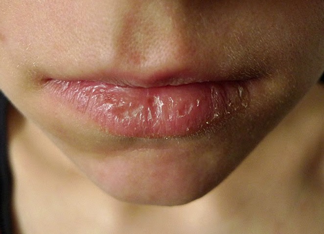 eczema-around-lip-pictures-photos