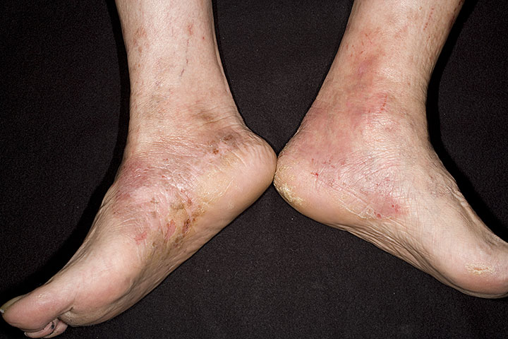 foot eczema pictures, photos