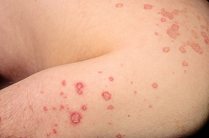 nummular eczema treatment pictures, photos