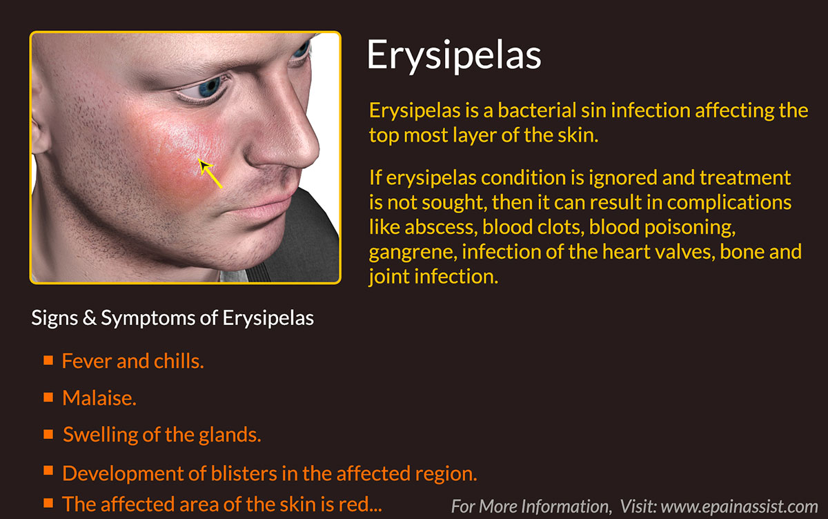 erysipelas treatment - pictures, photos